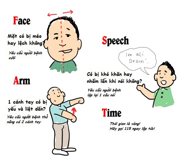 Chi tiết: Chứng đột quỵ khiến danh hài Chí Tài qua đời nguy hiểm cỡ nào? Cách phòng tránh và xử trí thần tốc tính bằng giây để thoát khỏi cửa tử - Ảnh 3.
