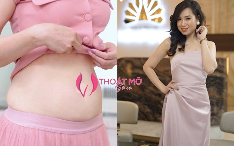 Phái đẹp ''lột xác'' hoàn hảo nhờ công nghệ  hút mỡ VASER LIPO đỉnh cao