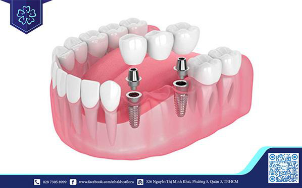 Tại sao bạn nên lựa chọn nha khoa uy tín để trồng răng Implant?